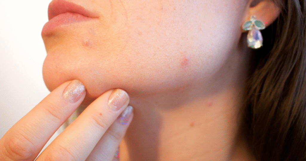 Get Rid of Acne Scars Naturally at Home"