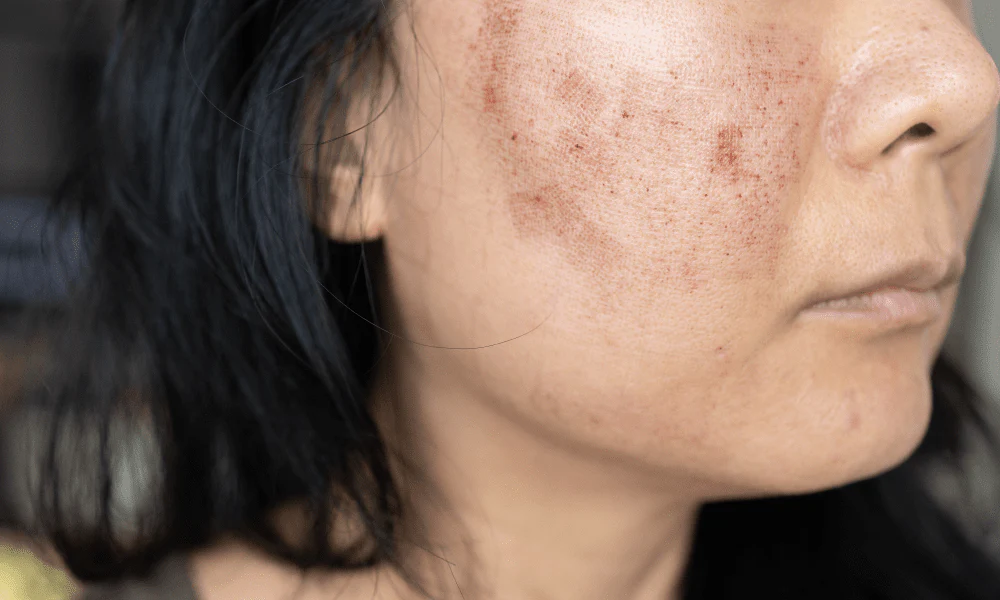 Ice Therapy for Face: Top Benefits, Safe Use & Expert Tips