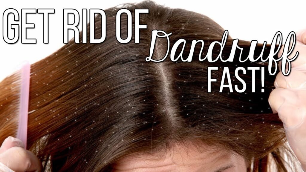 How to Get Rid of Dandruff Fast and Effectively